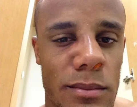 Photo : Kompany bien amoché